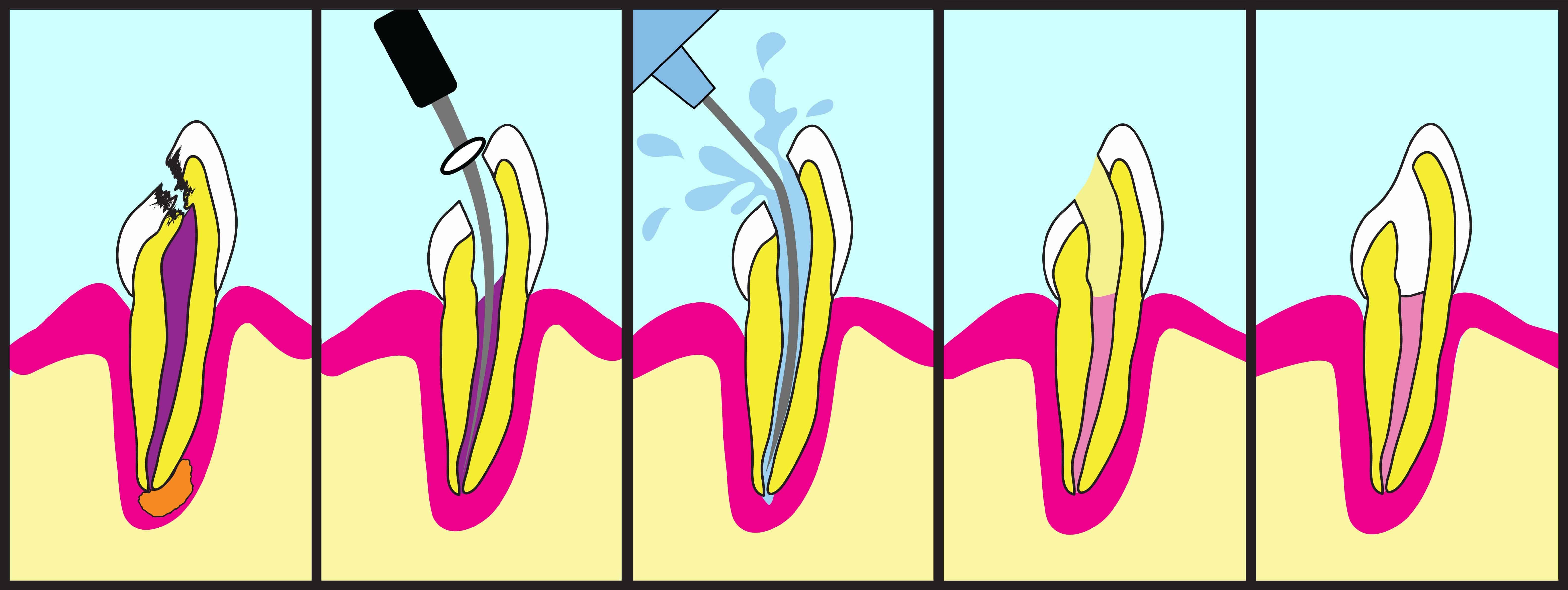 Root canal procedure