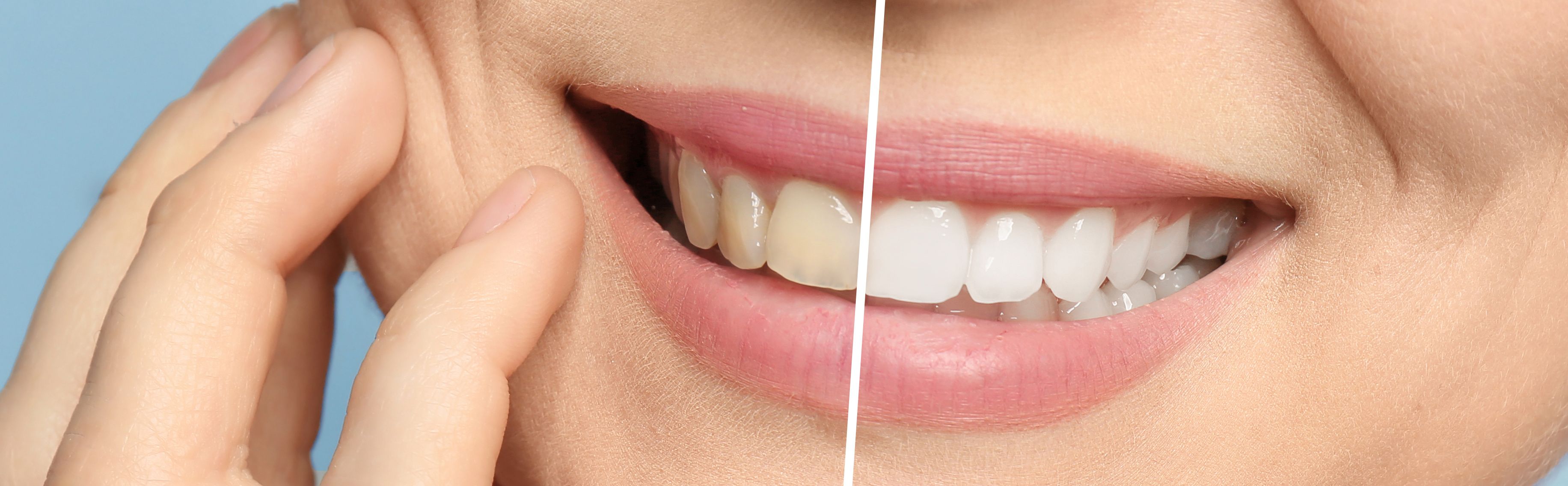 cost of zoom whitening
